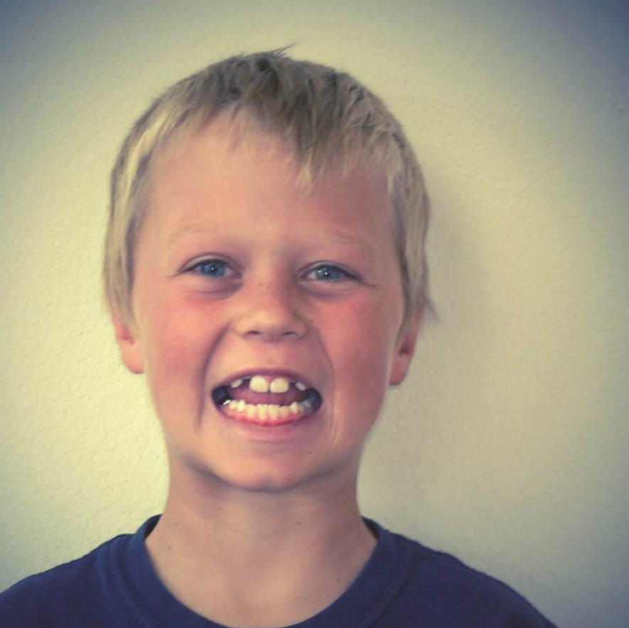 Evan Before Thatcher Orthodontics